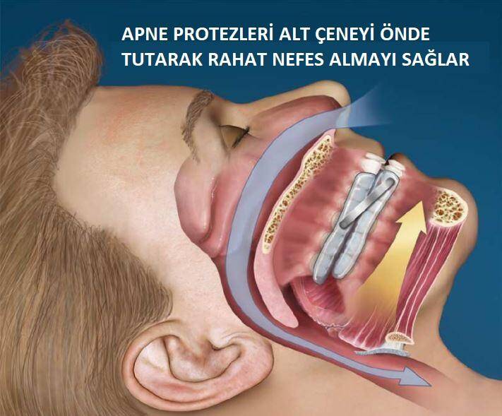 Horlama tedavisi şeması